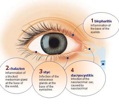 blepharitis causes and symptoms